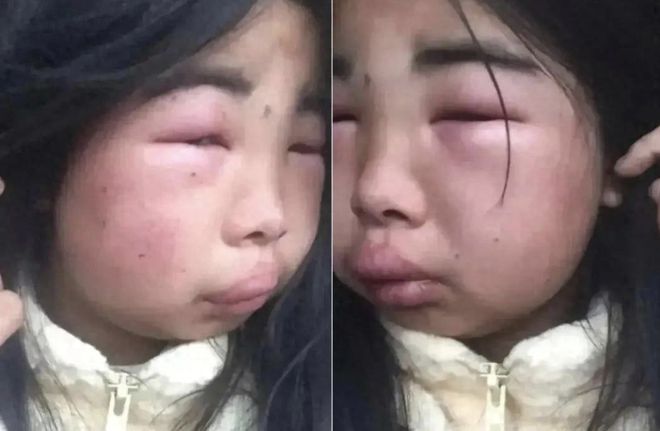 网曝12岁女孩感染HPV事件揭秘，真相与挑战的应对之道