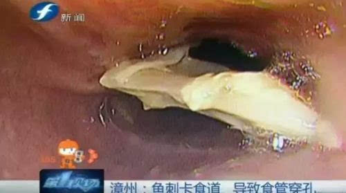 女子吃火锅鱼刺卡喉引发食管破裂危机