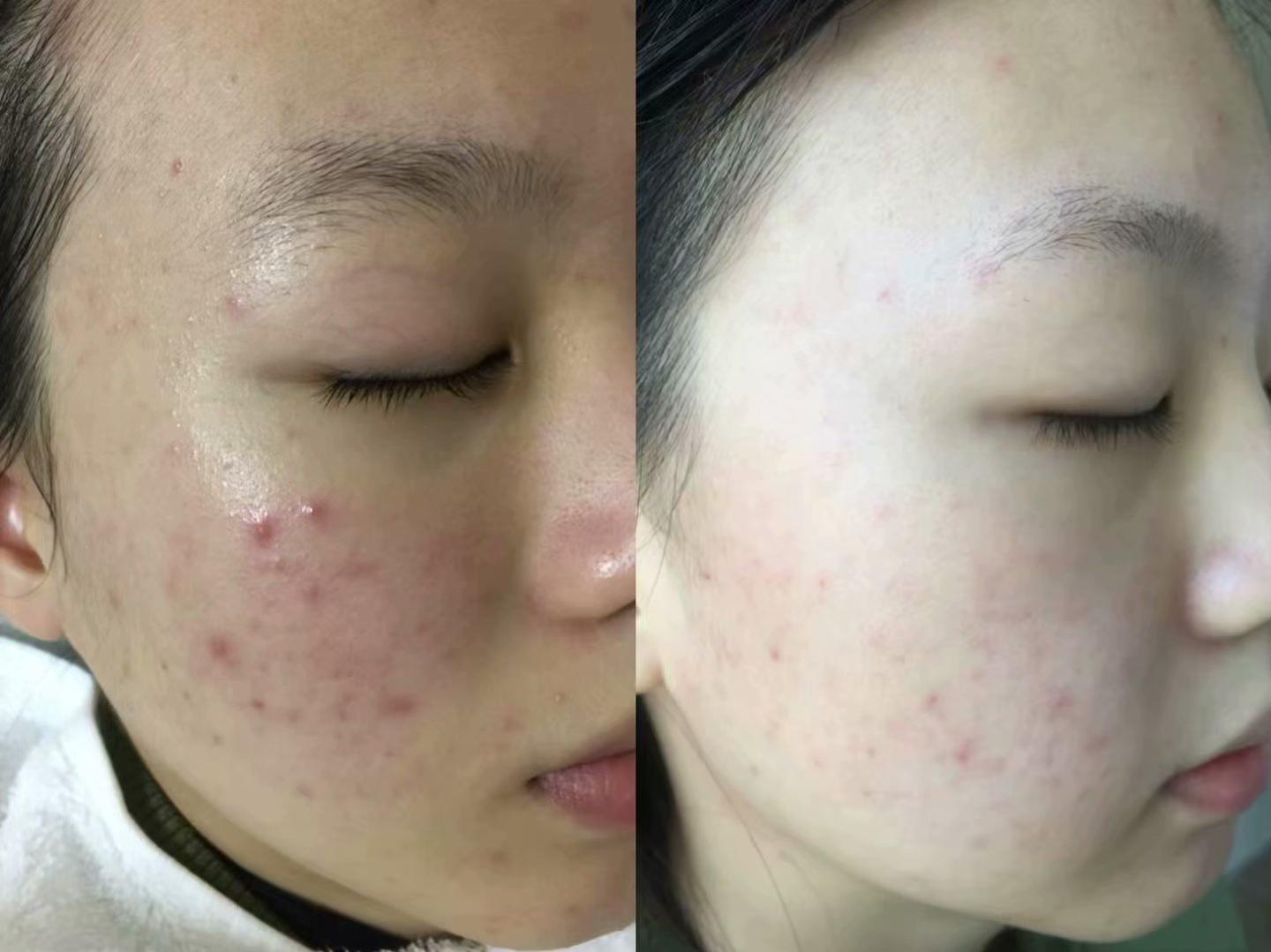 痘痘贴年收入达6亿，市场现象背后的成功解析与洞察