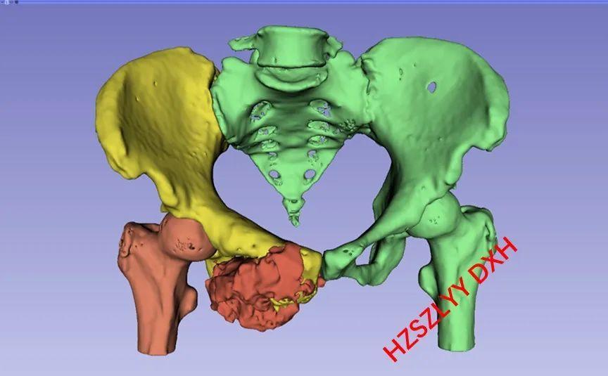 3D打印技术助力医疗领域定制化需求的改善